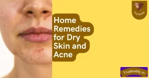Home Remedies for Acne and Dry Skin